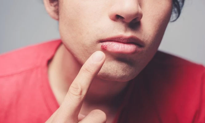 Έρπης: Γιατί είναι συχνότερος το καλοκαίρι;-Πόσο επηρεάζεται από την ηλιακή ακτινοβολία;-Βίντεο